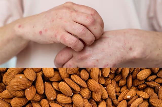 Almond Allergy Symptoms