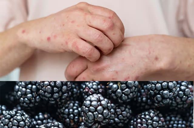 Blackberry Allergy Symptoms