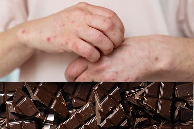 Chocolate Allergy Symptoms