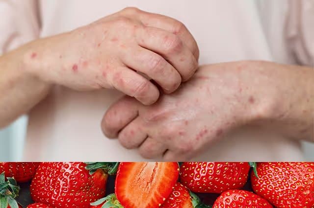 Do Strawberries Cause Hives