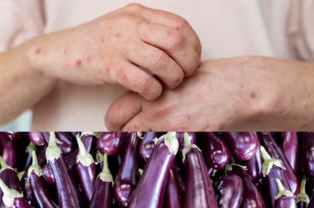 Eggplant Allergy Symptoms