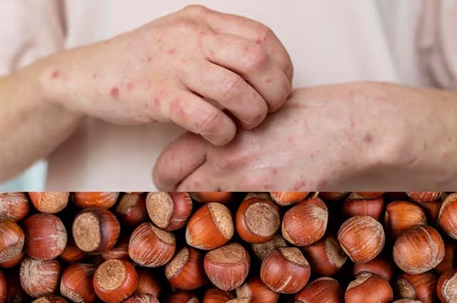 Hazelnut Allergy Symptoms