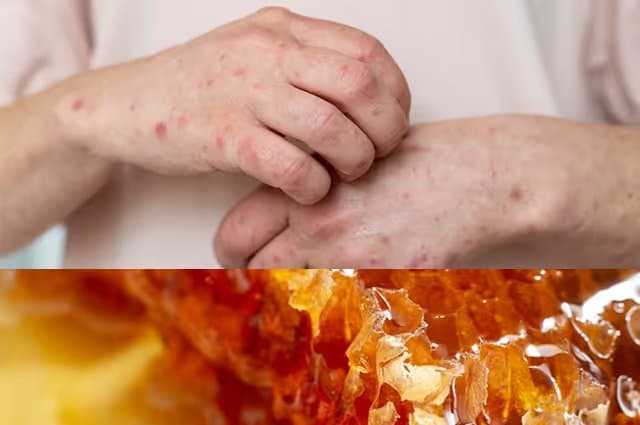 Honey Allergy Symptoms