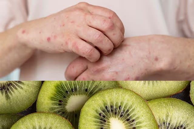 Kiwi Allergy Symptoms