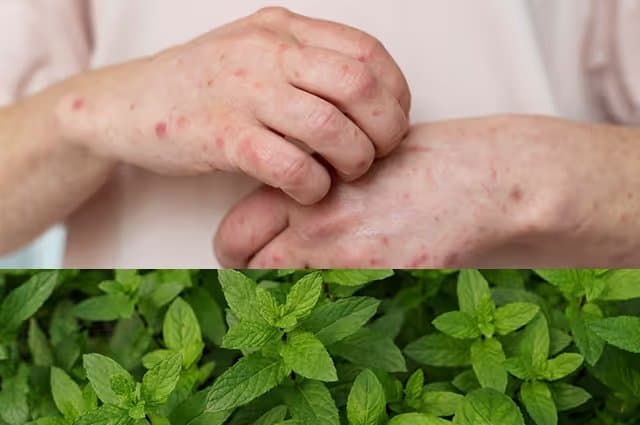 Mint Allergy Symptoms