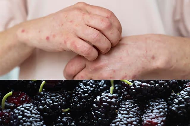 Mulberry Allergy Symptoms