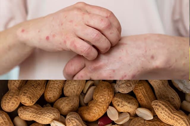 Peanut Allergy Symptoms