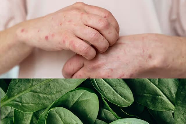 Spinach Allergy Symptoms