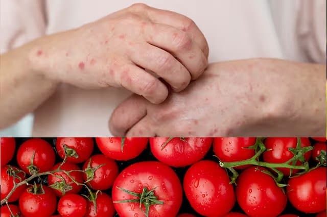 Tomatoes Allergy Symptoms